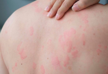 Photo of Urticaria crónica, todo sobre la enfermedad de las ronchas que afecta a 100.000 argentinos