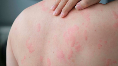 Photo of Urticaria crónica, todo sobre la enfermedad de las ronchas que afecta a 100.000 argentinos