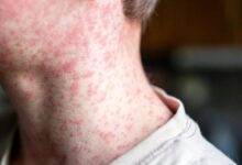 Photo of Salud refuerza la lucha contra el sarampión con una nueva jornada de vacunación en el AMBA